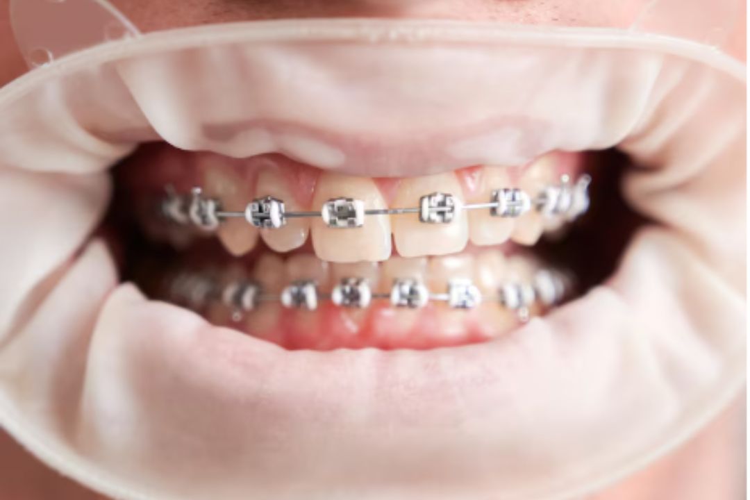 braces for 4 front teeth only cost in mumbai
